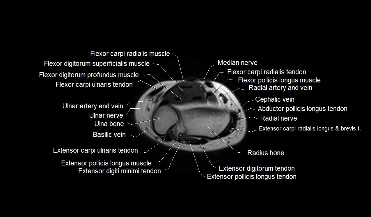 MRI 3T forearm axial cross sectional anatomy image 43.webp